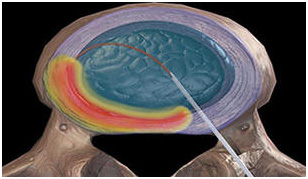 Ứng dụng sóng cao tần thế hệ mới trong phẫu thuật cột sống ít xâm lấn