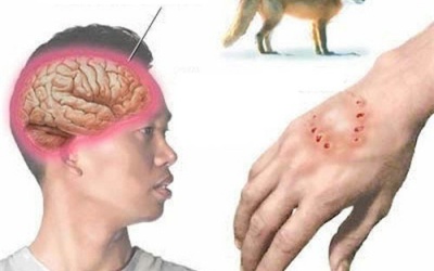 Xử trí đúng để tránh tử vong do bệnh dại