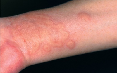 Bệnh nổi mề đay trị dứt điểm như thế nào?