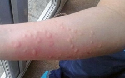 Mề đay lạnh - Căn bệnh không chỉ riêng mùa Đông