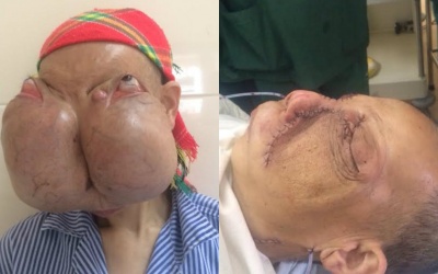 Cắt bỏ khối u khổng lồ làm biến dạng mặt nữ bệnh nhân