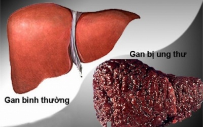 Những người nào dễ mắc bệnh ung thư gan?