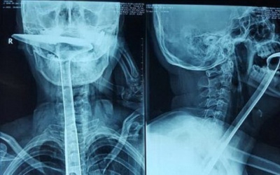 Suýt chết vì dùng xẻng nấu ăn thông cổ họng
