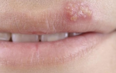 Biến đổi virus herpes thành vaccine điều trị ung thư da