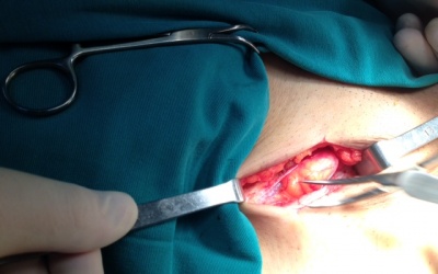 ​Phương pháp mới điều trị thoát vị bẹn