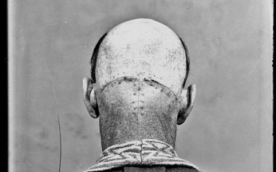 Những bệnh nhân được phẫu thuật não đầu tiên trên thế giới