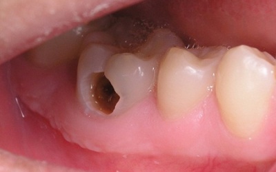 5 'thủ phạm' gây sâu răng ít ngờ tới