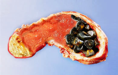 Bị sỏi mật do thói quen ăn uống