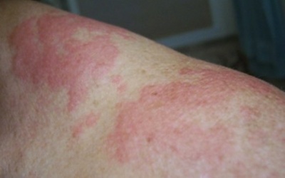 Mề đay tự phát song hành cùng bệnh tuyến giáp