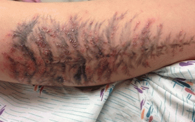 Rùng mình cảnh vết xăm mình bị mưng mủ