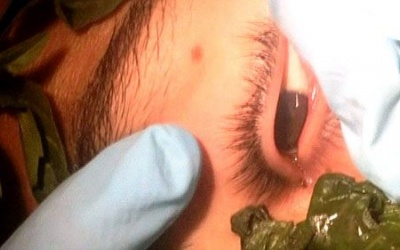 Bắt con sâu dài 3cm trong mắt thiếu niên 17 tuổi