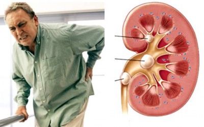Những biến chứng không ngờ từ sỏi thận