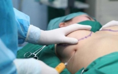 Bơm ngực bằng mỡ tự thân: Liệu có an toàn?