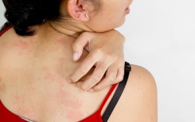 Hè về, bệnh mề đay “ngóc đầu” đón nắng