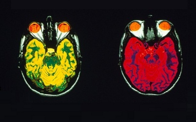 Nhóm máu cổ xưa giúp ngăn ngừa Alzheimer