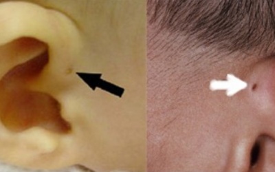 Cẩn trọng với bệnh dò luân nhĩ ở trẻ sơ sinh