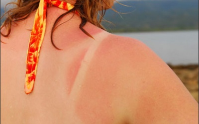 Những điều cần làm khi bị cháy nắng