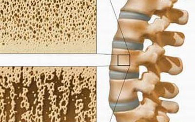 Cách thức mới điều trị loãng xương