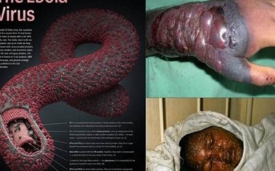 10 căn bệnh nguy hiểm khiến cả thế giới phải khiếp sợ