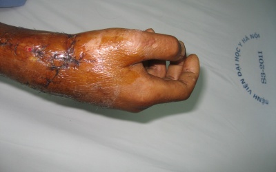 Bệnh viện Đại học Y Hà Nội ghép thành công bàn tay bị đứt rời