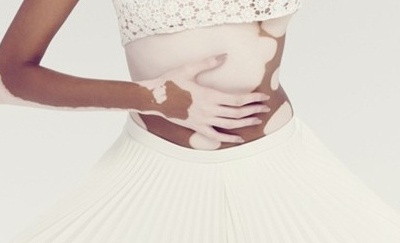 Một số phương pháp tự nhiên điều trị bạch biến