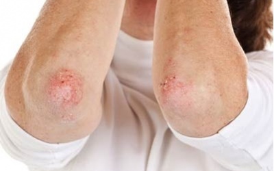 Mùa hè cẩn trọng với các bệnh về da