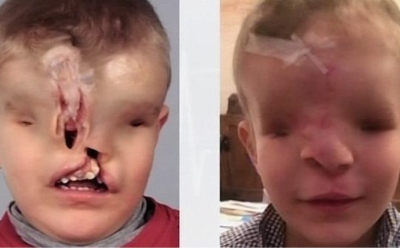 Cậu bé sinh ra không có mắt, mũi được tái tạo khuôn mặt