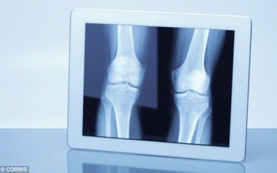 Phát hiện 1 hormone do xương sản xuất giúp giảm cân