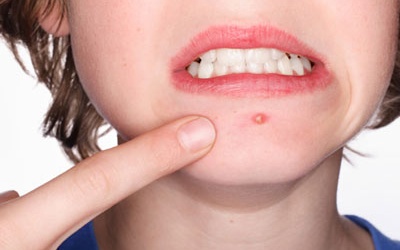 Chữa mụn nhọt như thế nào?