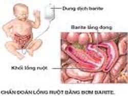 Phẫu thuật tháo lồng ruột cho bệnh nhân bị bệnh hiếm 