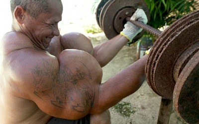 Thảm họa với quý ông khi bơm dầu vào cánh tay để tạo cơ bắp