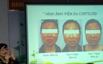 Hiểm hoạ từ công thức chế kem đẹp da có chứa corticoid