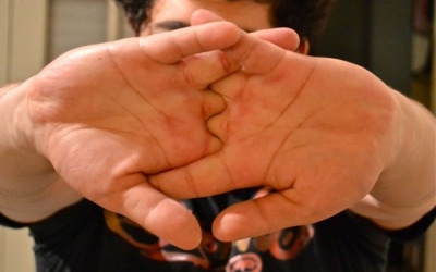 Vì sao không nên bẻ khớp ngón tay?