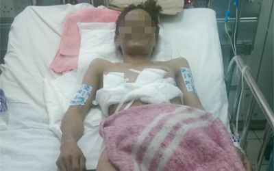 Cứu sống bệnh nhân bị cuốn vào máy hút cát rách toác lồng ngực