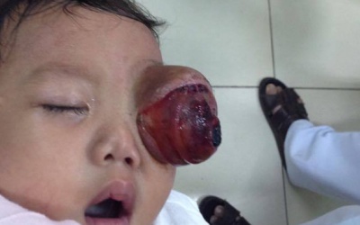 Lần đầu tiên phẫu thuật thành công ca u bào võng mạc