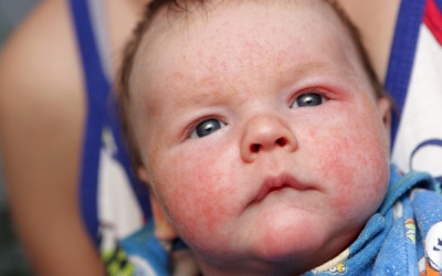 Điều trị trẻ bị chàm sữa như thế nào?