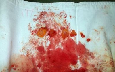 Hàng trăm khối silicon vón cục trong ngực bệnh nhân