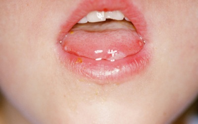 Nổi mụn trong miệng có phải bệnh tay chân miệng?