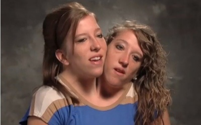 Cuộc sống của cặp song sinh 2 đầu trên cùng 1 cơ thể