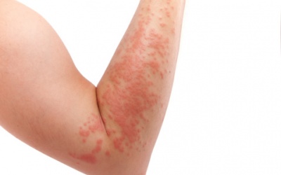 Cách điều trị và phòng ngừa bệnh chàm