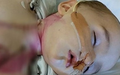 Bé 8 tháng tuổi bất động vĩnh viễn vì nuốt phải pin