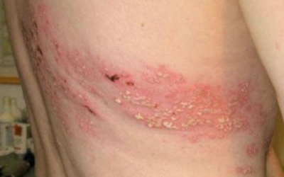 Điều trị tận gốc bệnh zona như thế nào?