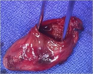 Đề phòng viêm túi mật cấp do sỏi mật