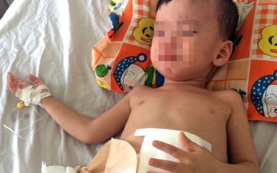 Bé 3 tuổi phải cấp cứu sau cú đạp của cha dượng