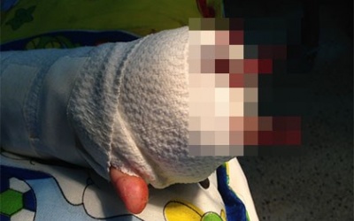 Bé trai đứt bốn ngón tay do chơi xe đạp điện