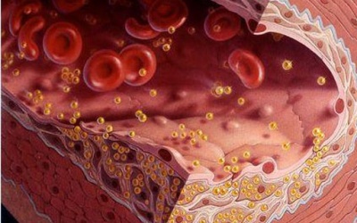 Hiểu đúng công và tội của statin