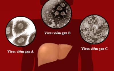 8 triệu người Việt đang bị viêm, xơ và ung thư gan