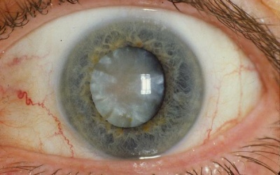 Chữa đục thuỷ tinh thể bằng thuốc… nhỏ mắt