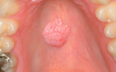 Dùng chung bàn chải đánh răng, nữ sinh mắc sùi mào gà