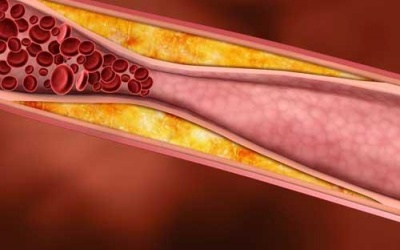 Giảm cholesterol với 10 bước đơn giản